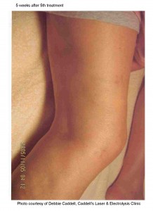 Dr. Gurley can help eliminate varicose veins and spider veins with laser therapy