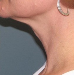 Atlanta SkinPen - neck