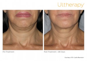 Dr. Gurley features Ultherapy, the only FDA-approved non-invasive device that uses micro-focused ultrasound to lift skin on the face and neck. The results for plastic surgery without going under the knife.